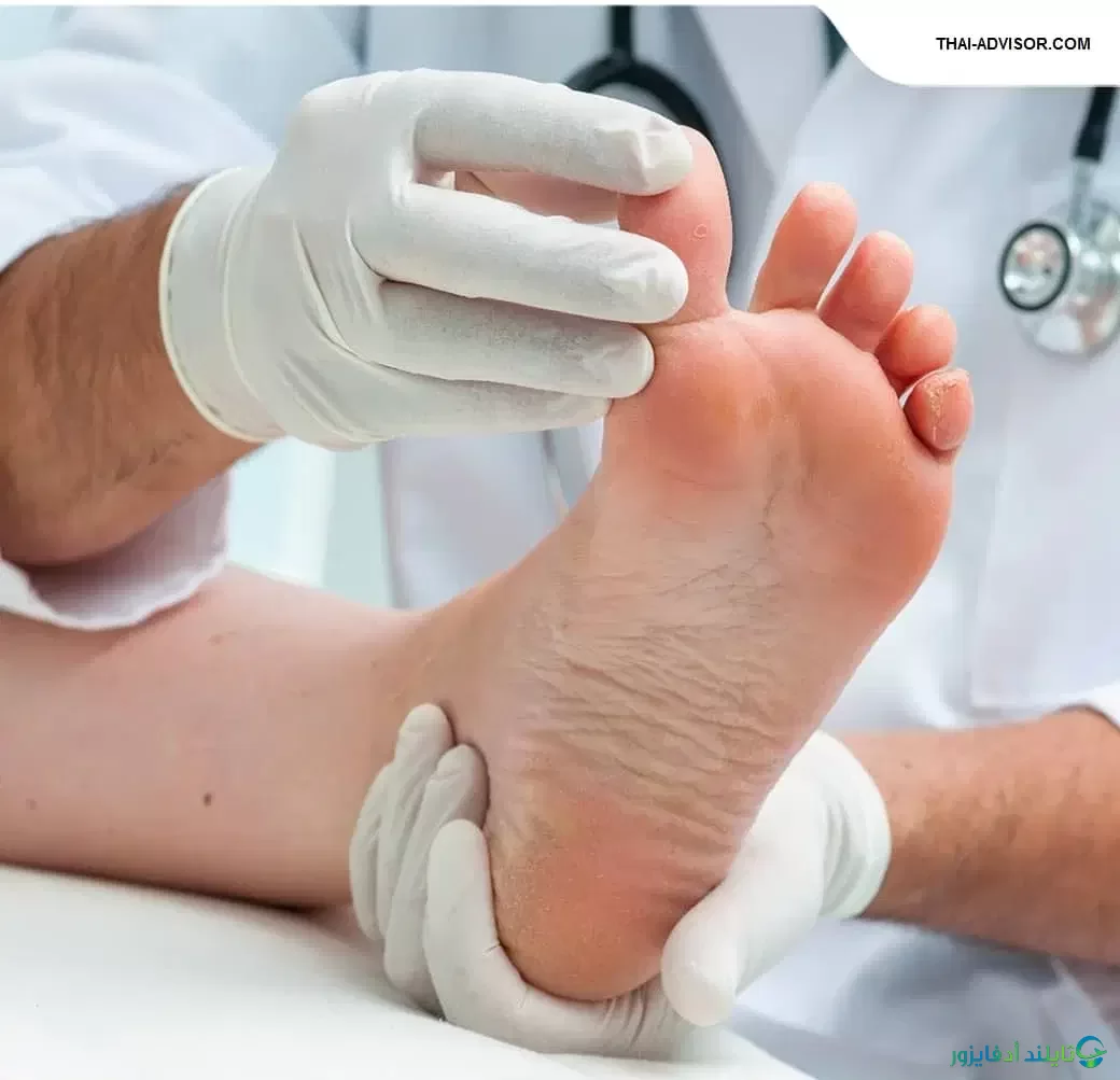 أسباب وأعراض وطرق العلاج الصحيحة لجروح القدم لمرضي السكري