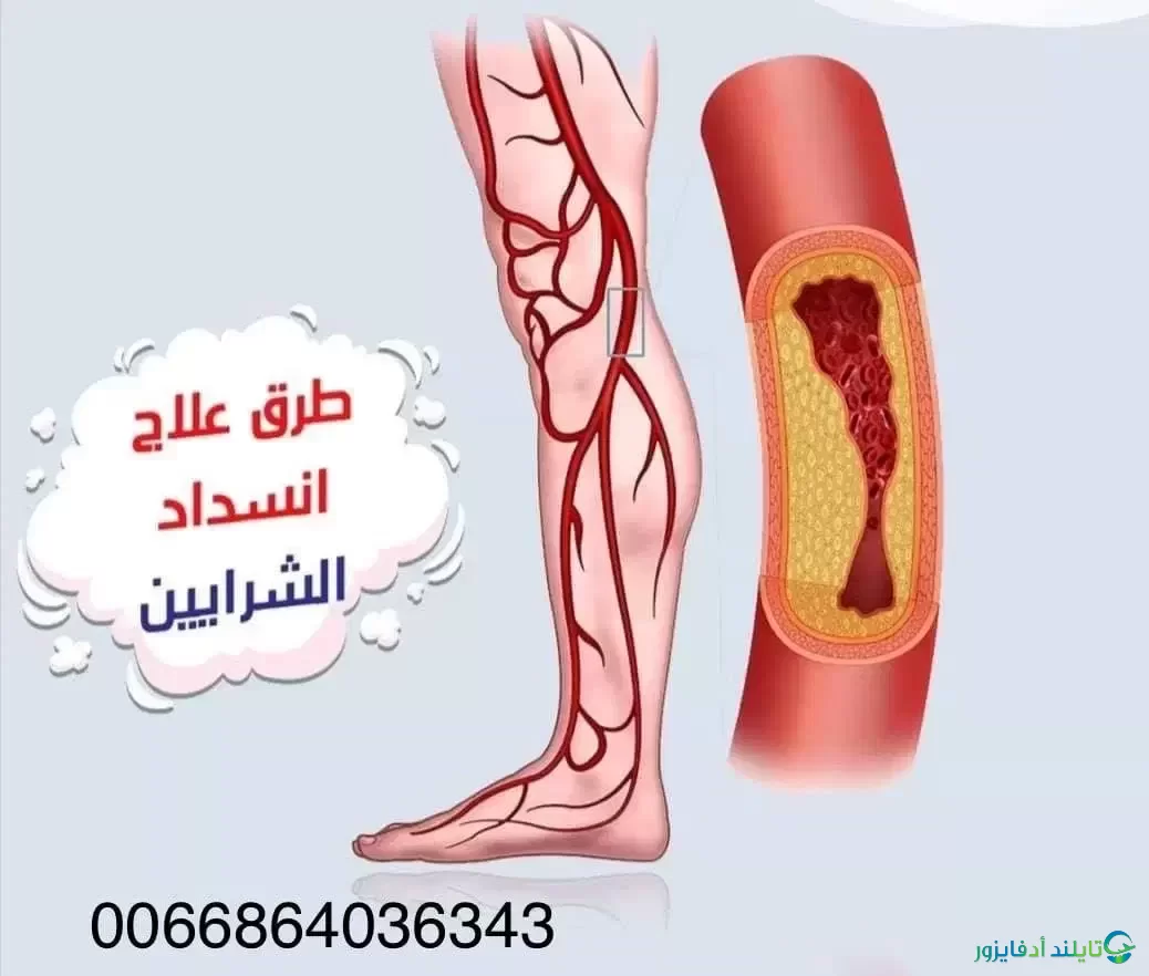 قرحة القدم لمرضي السكري خطر صامت لحدوث الغرغرينا: Gangrene