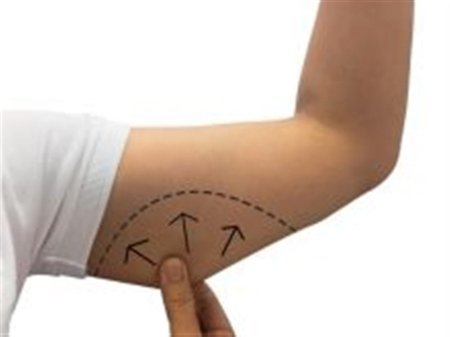 جراحة شفط دهون الذراعين وشدها بافضل عيادات التجميل في بانكوك